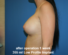 plastic-surgery-breast-augmentation